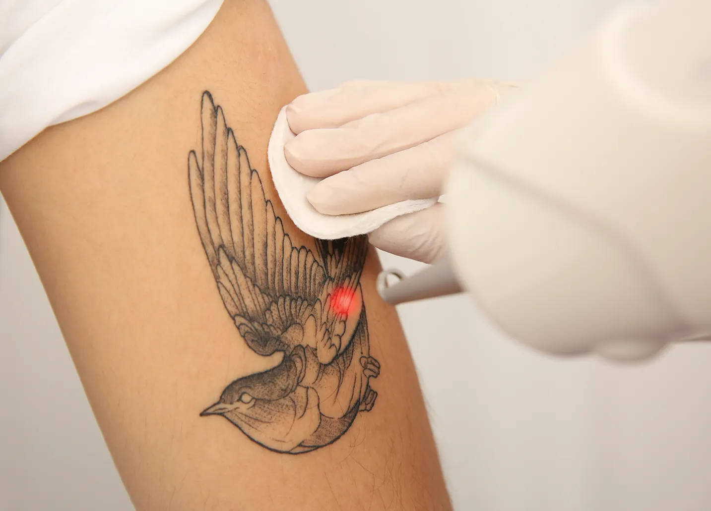 rimozione tattoo laser